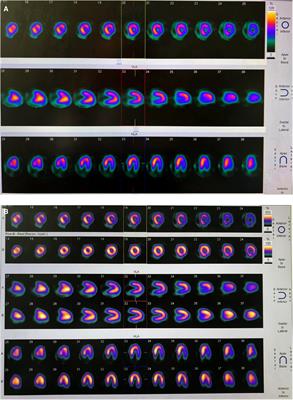 Case Report: Interventional therapy for coronary artery occlusion in a 6-year-old child with Kawasaki disease